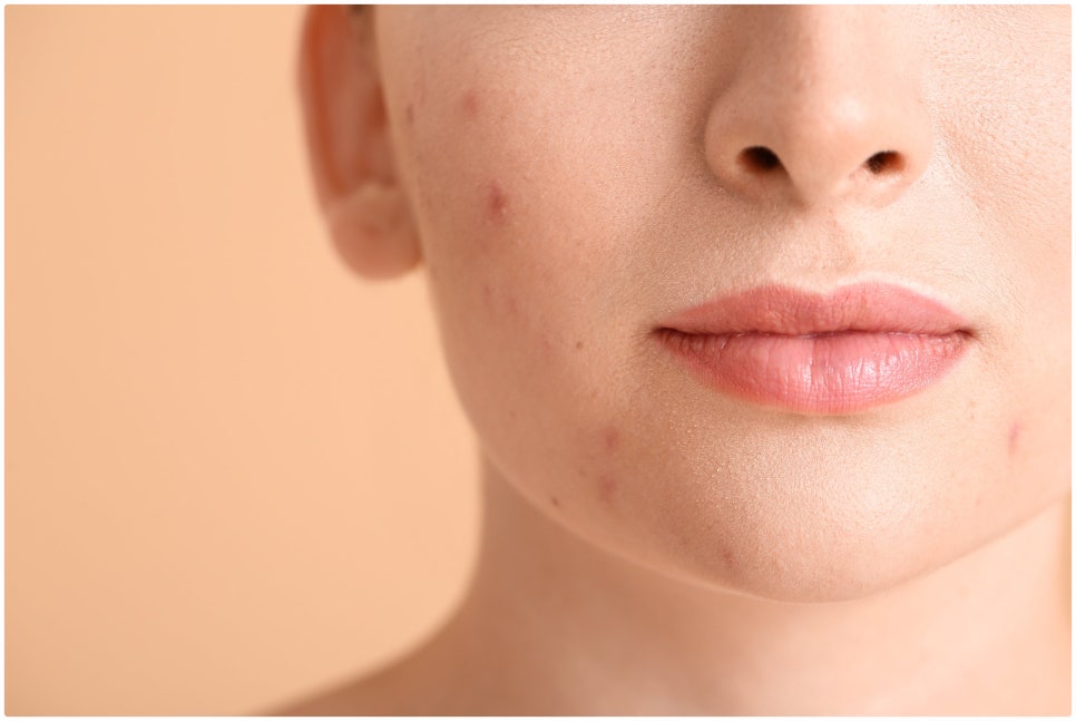 If You’re Stressed by Acne Scars, Yeoksam Gold PTT image 4