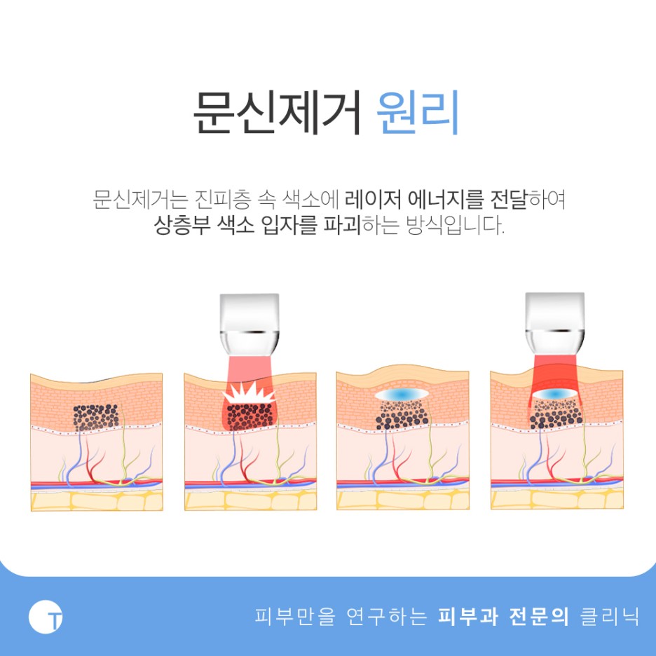 강남문신제거 전문의가 맞춤으로 진행하는 관련 이미지 2