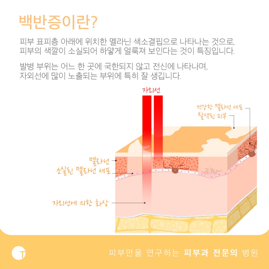 백반증과 건선 치료가 필요하다면 관련 이미지 2