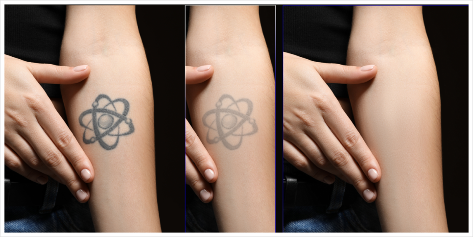 Why You Should Get Tattoo Removal at a Place That Specializes in Gangnam Yeoksam Tattoo Removal image 2