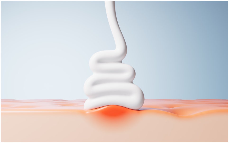 Achieve Clear Skin with Gold PTT for Acne Treatment at Yeoksam Station image 5
