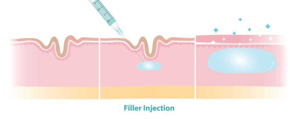 Gangnam Yeoksam Filler: What to Consider for Natural-Looking Changes image 2