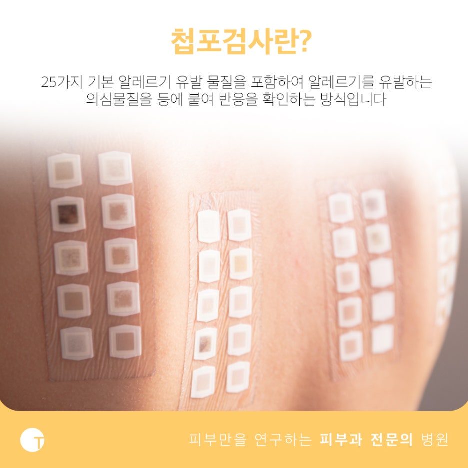 알레르기 첩포검사 의심물질을 확인해요 관련 이미지 2