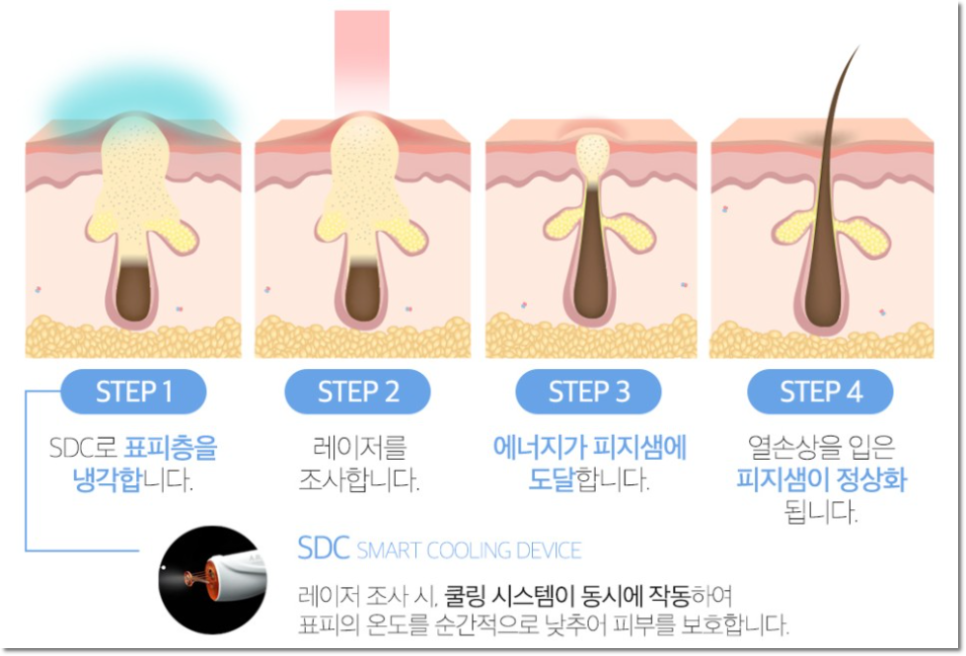 역삼동여드름제거 아트레이저의 장비로 관련 이미지 3