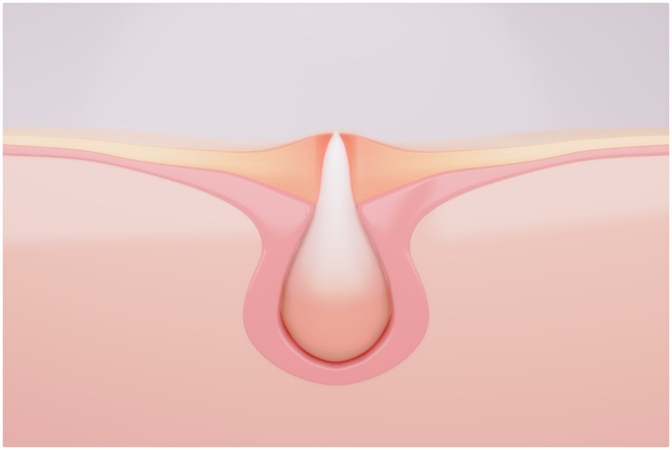 Achieve Clear Skin with Gold PTT for Acne Treatment at Yeoksam Station image 4