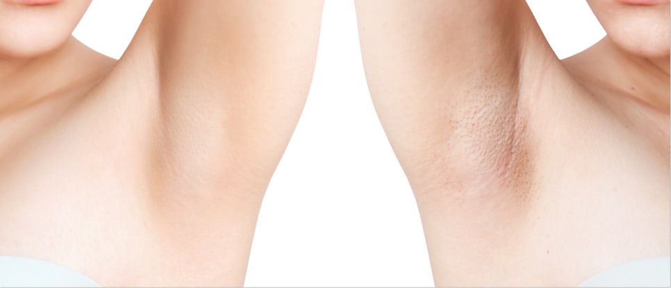역삼역제모 잘하는 곳을 찾고 있다면 관련 이미지 3