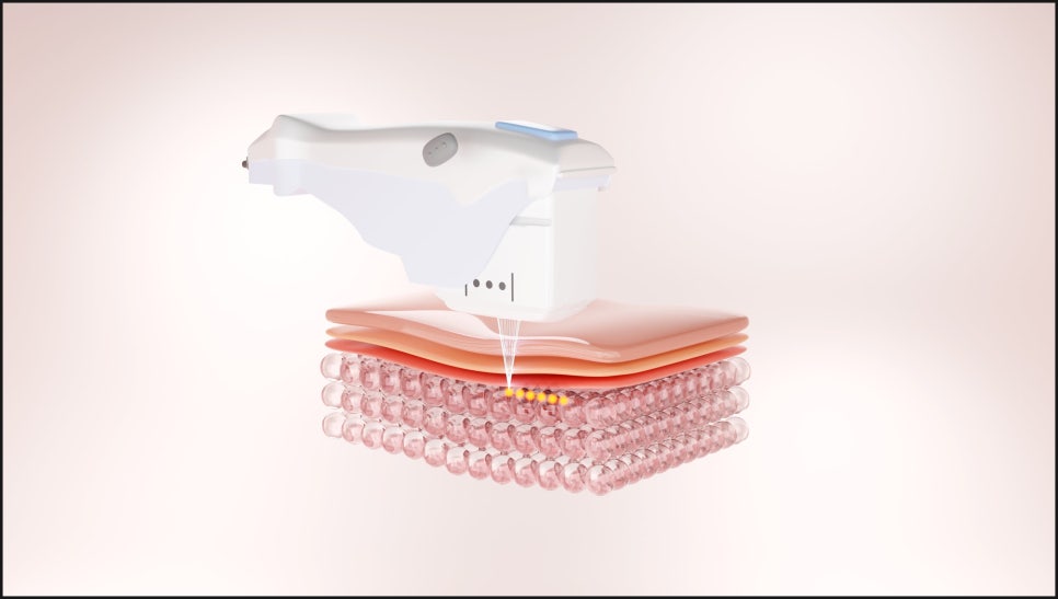 Why You Should Make a Careful Decision About Gangnam Ultherapy image 2