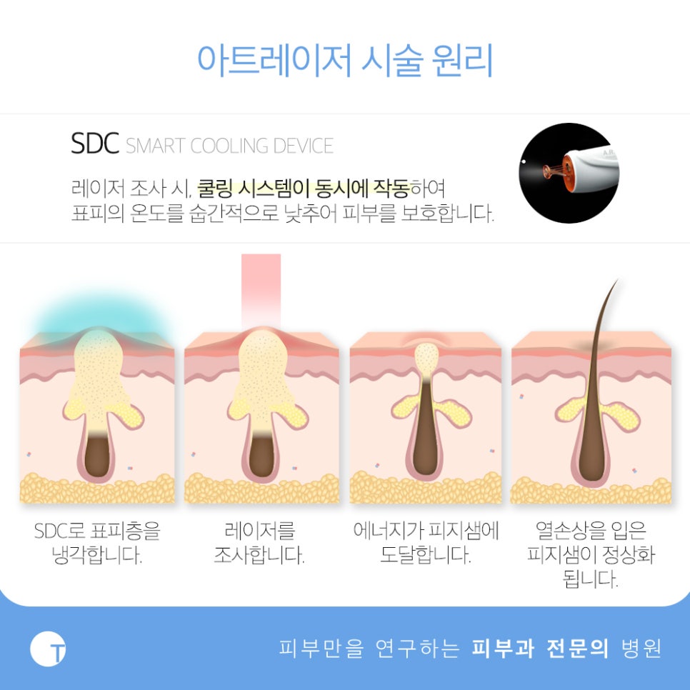 역삼역여드름 아트레이저로 관리해요 관련 이미지 4