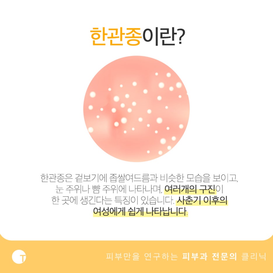 한관종 아그네스 치료 재발 없이 확실하게 관련 이미지 2