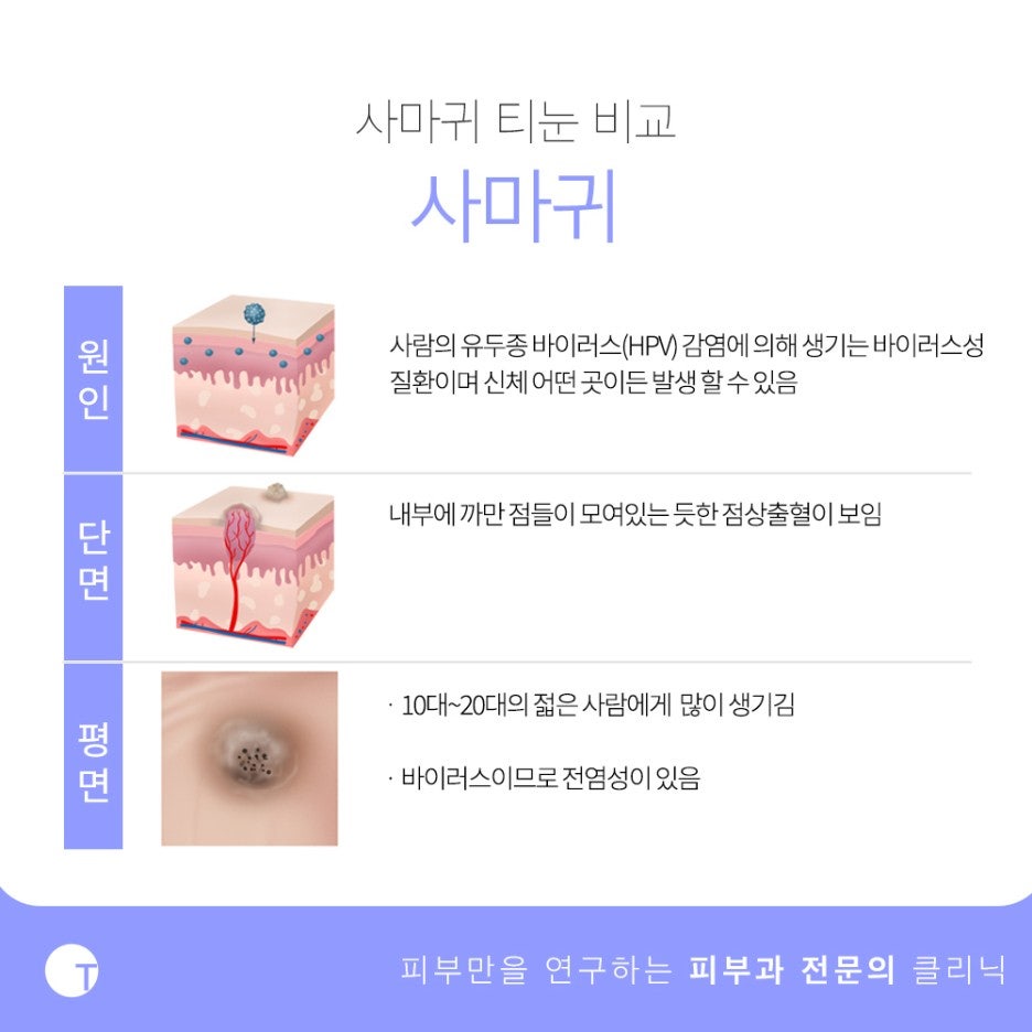 역삼역사마귀치료 확실하게 제거하기 위해서는 관련 이미지 3