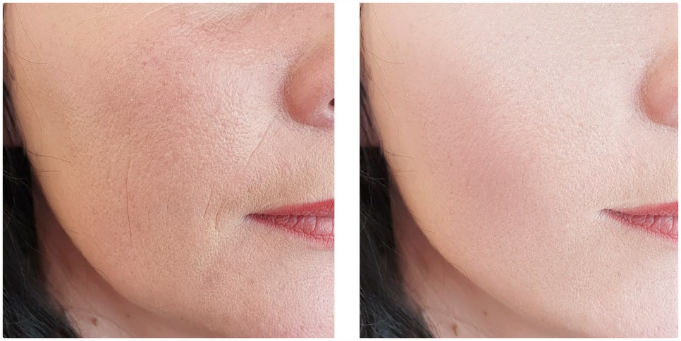 How to Improve Sagging Skin with Yeoksam Liftera image 3