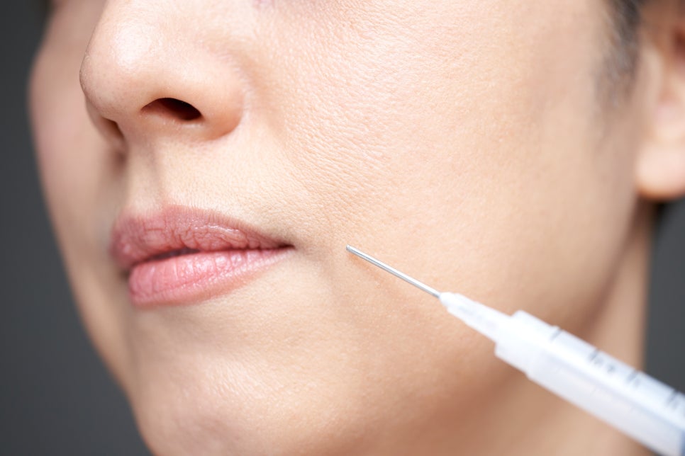 Radiesse at Yeoksam Station: If You Are Concerned About Volume Loss and Wrinkles image 1
