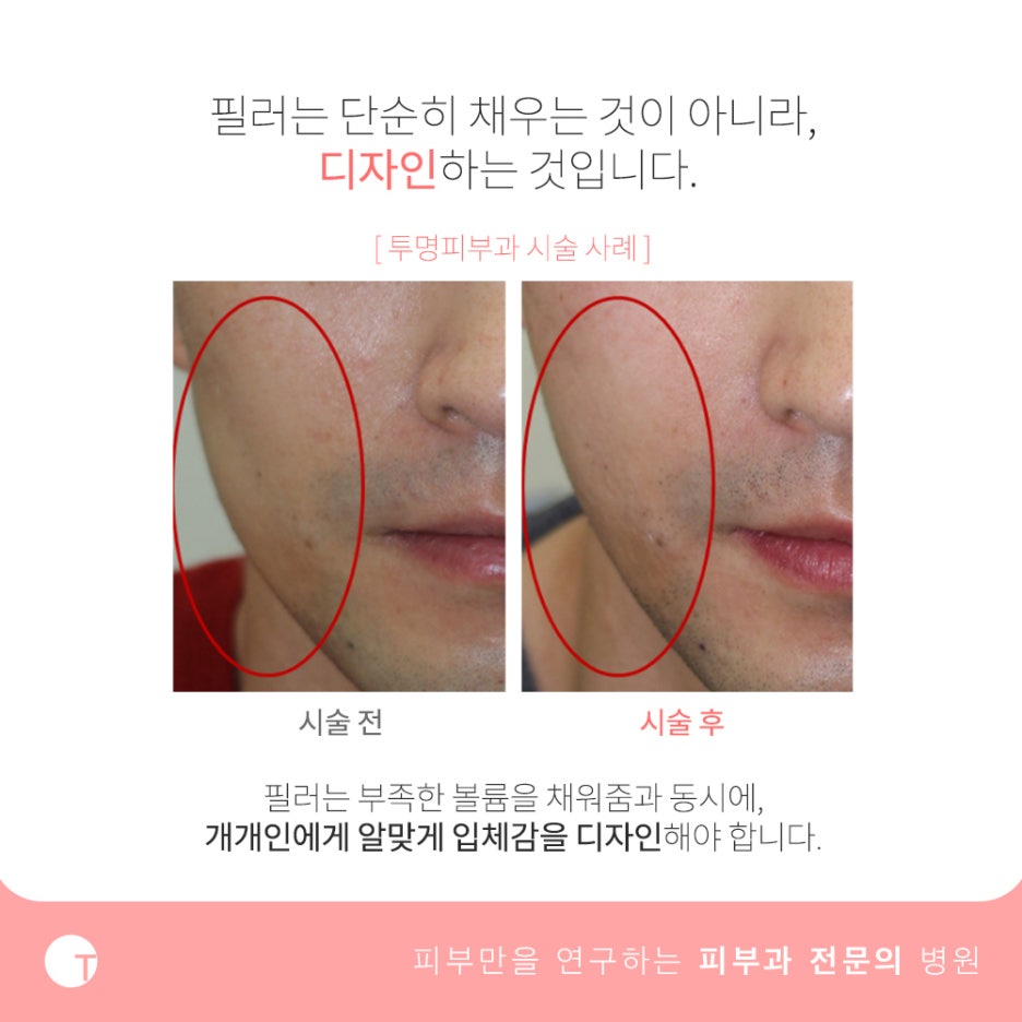 역삼역볼필러 얼굴라인을 교정해요 관련 이미지 4
