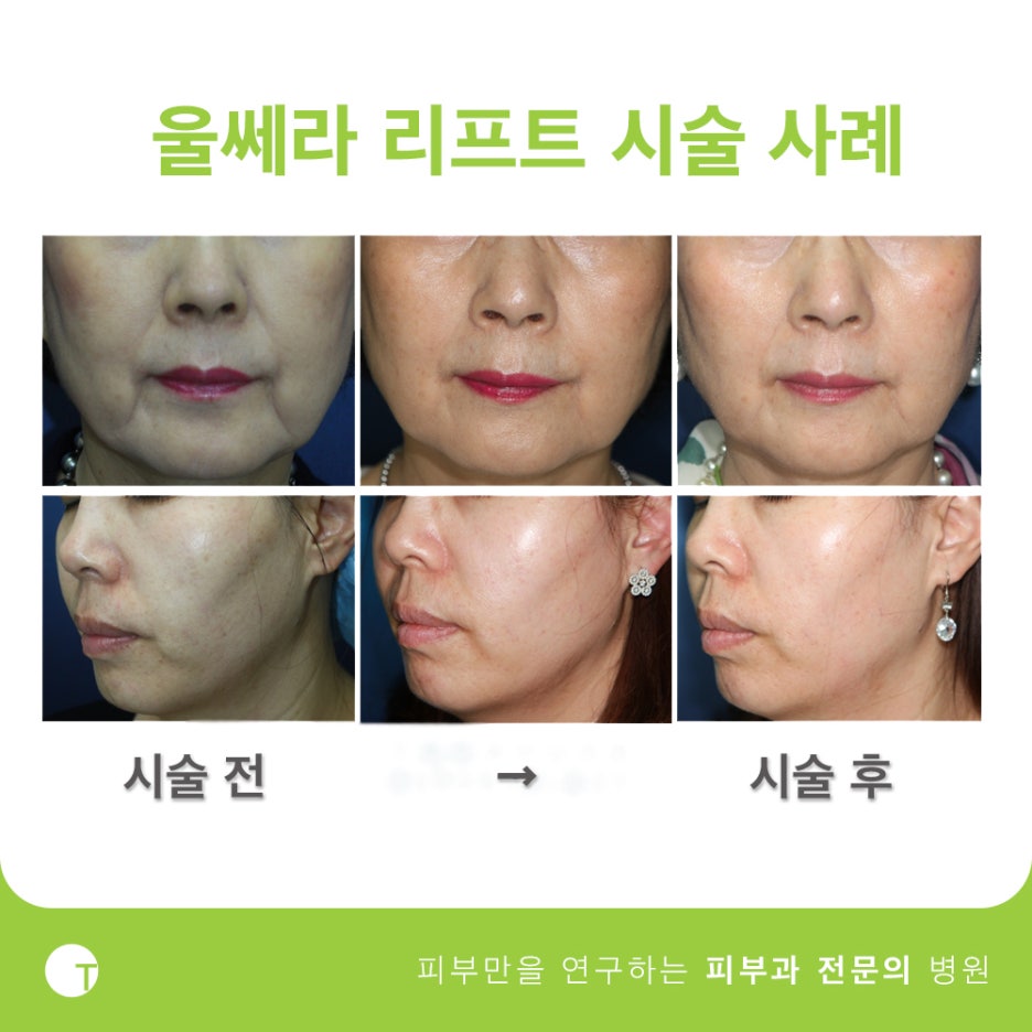 역삼동울쎄라 탄력을 채워드려요 관련 이미지 7