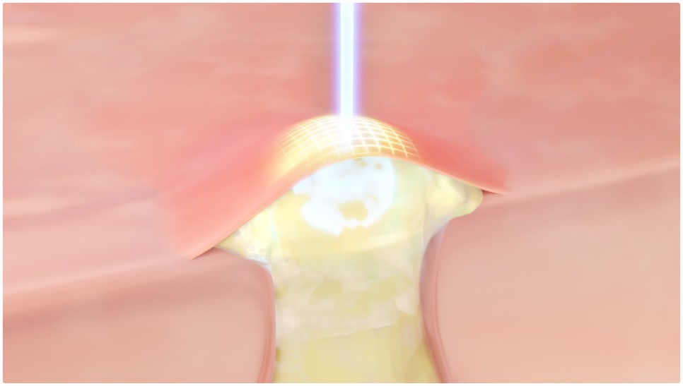 Achieve Clear Skin with Gold PTT for Acne Treatment at Yeoksam Station image 2