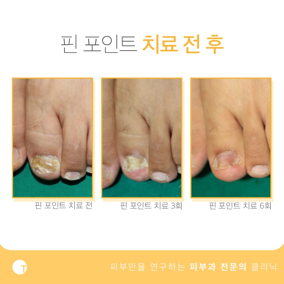 발가락 사이 간지러움 무좀을 의심해 봐야 관련 이미지 5
