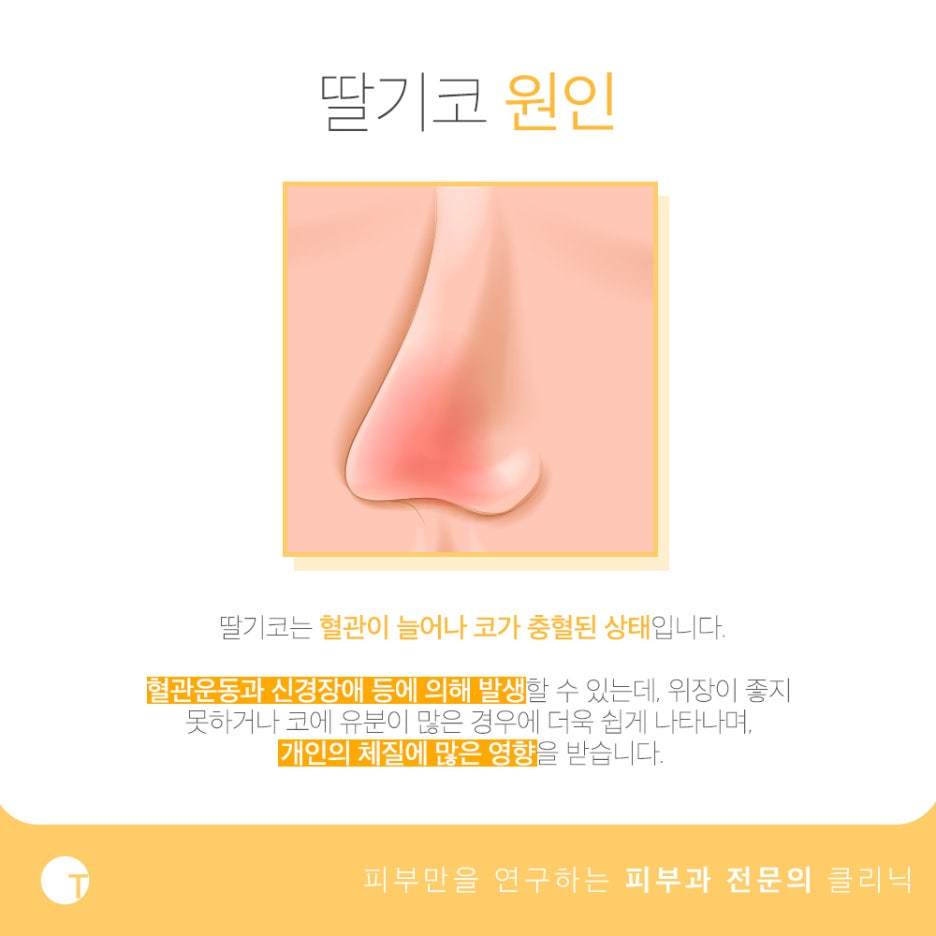 딸기코 치료 브이빔으로 환하게 관련 이미지 2