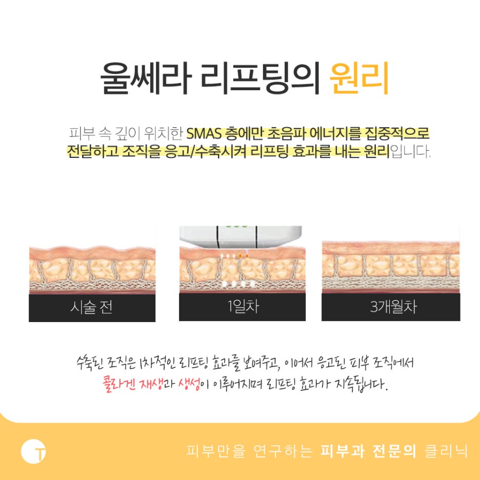울쎄라 리프팅 통증 걱정된다면 관련 이미지 3