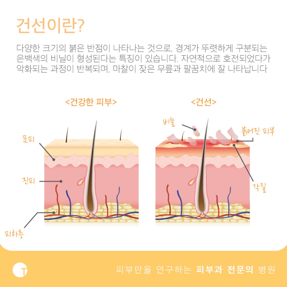 백반증과 건선 치료가 필요하다면 관련 이미지 3
