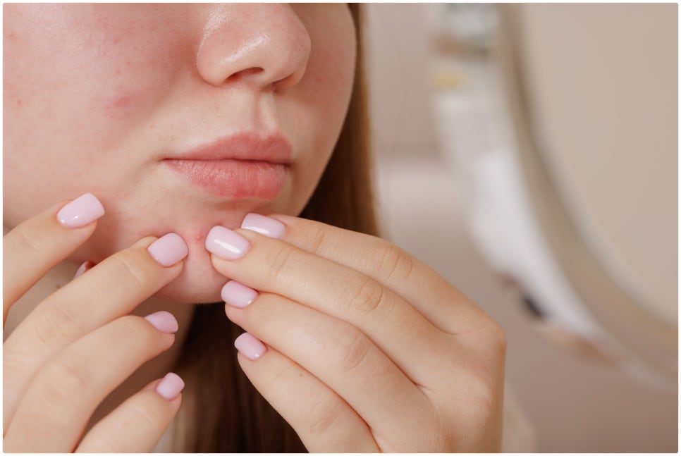 Achieve Clear Skin with Gold PTT for Acne Treatment at Yeoksam Station image 1