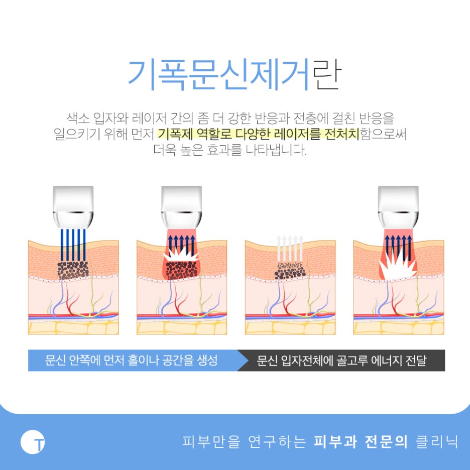 강남타투제거 기폭문신제거의 차이점은 관련 이미지 3