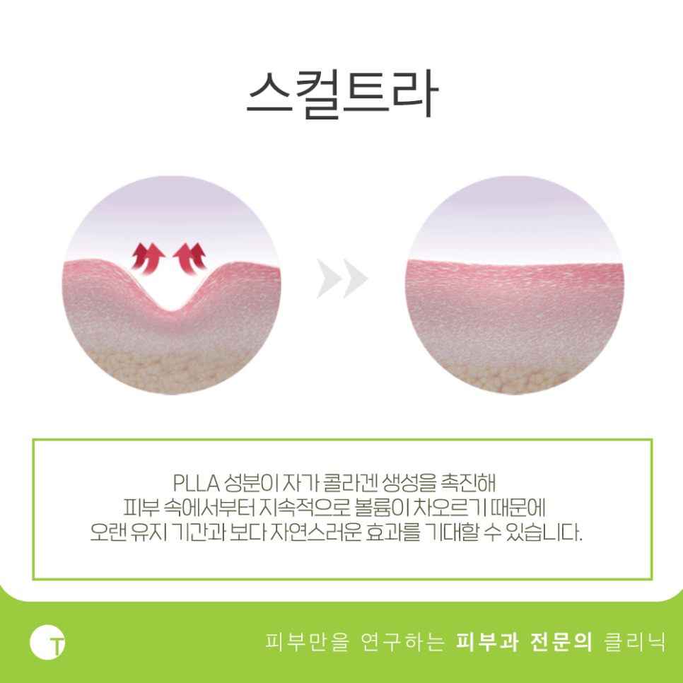 역삼스컬트라 볼륨은 채우고 주름은 펴주는 관련 이미지 2