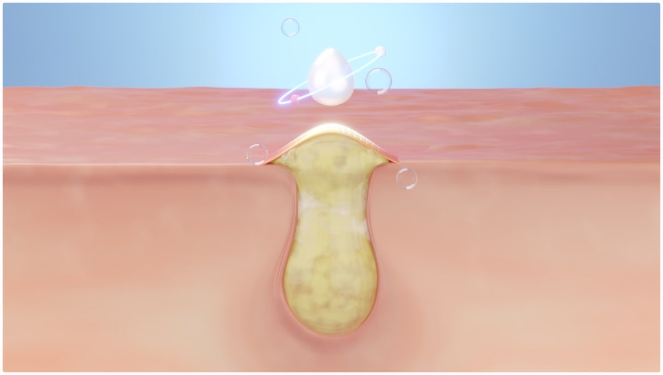Achieve Clear Skin with Gold PTT for Acne Treatment at Yeoksam Station image 3