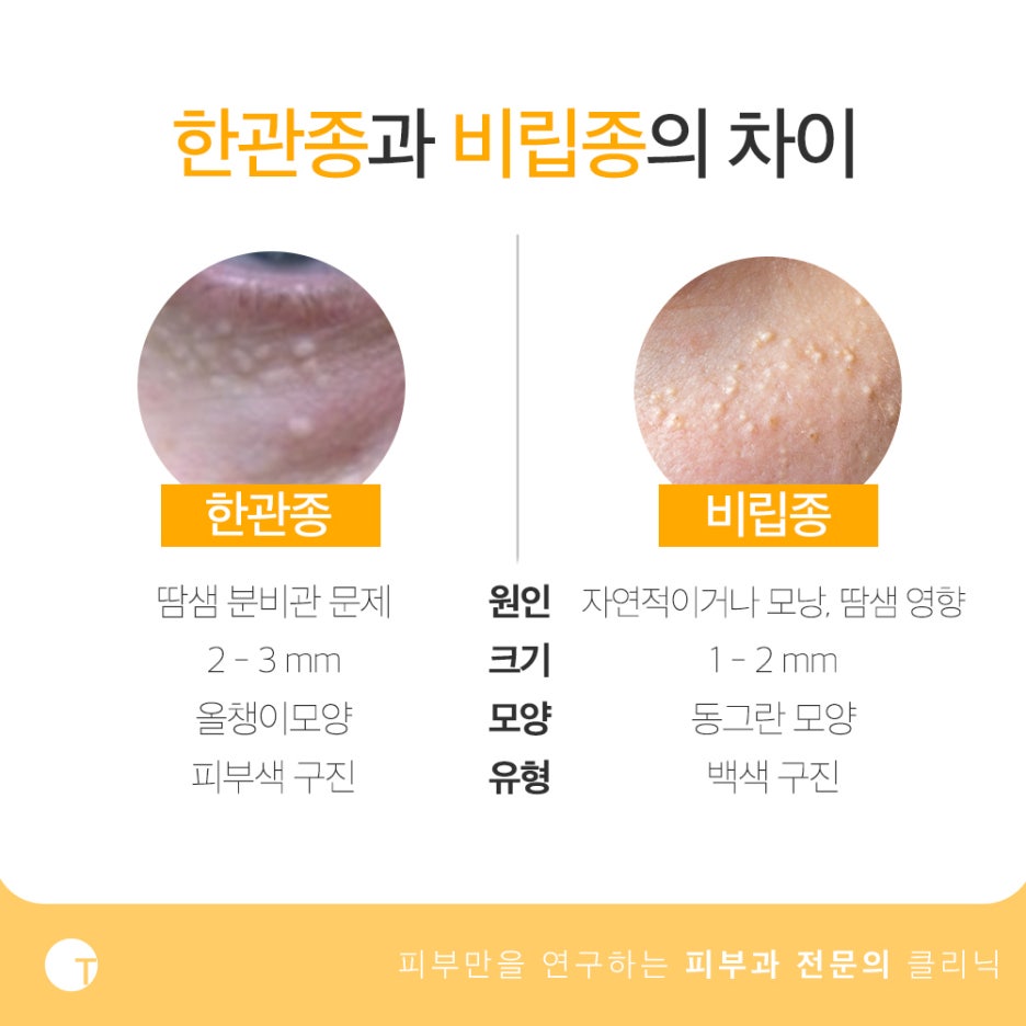 한관종 아그네스 치료 재발 없이 확실하게 관련 이미지 3