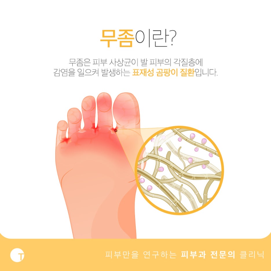 발가락 사이 간지러움 무좀을 의심해 봐야 관련 이미지 2
