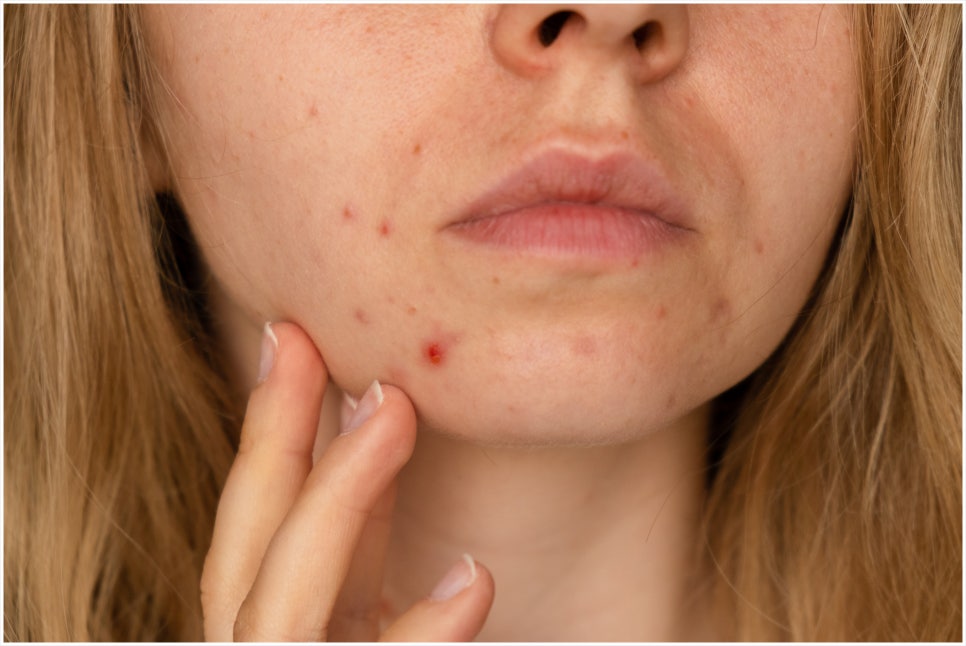 What Are the Effects of Neuramis Skin Enhancer, and How Is It Different from Other Skin Boosters? image 4