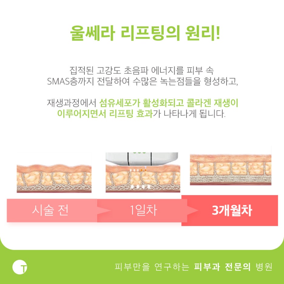 역삼동울쎄라 탄력을 채워드려요 관련 이미지 3