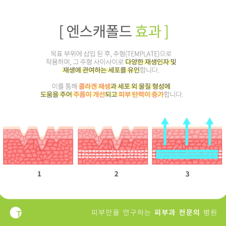 역삼역실리프팅 엔스캐폴드로 주름은 없애고 탄력은 살리고 관련 이미지 3