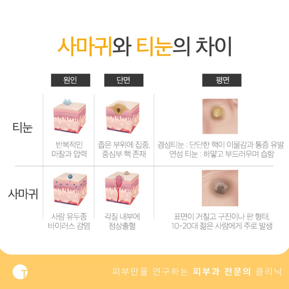 사마귀 티눈 냉동치료 방식과 장점은 관련 이미지 2
