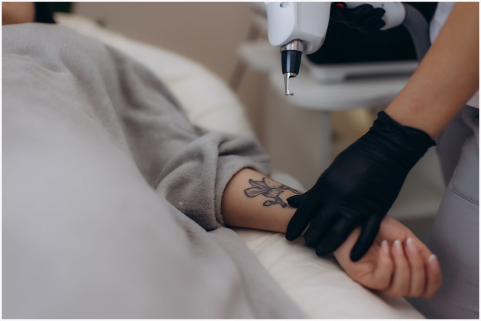 Why You Should Get Tattoo Removal at a Place That Specializes in Gangnam Yeoksam Tattoo Removal image 1