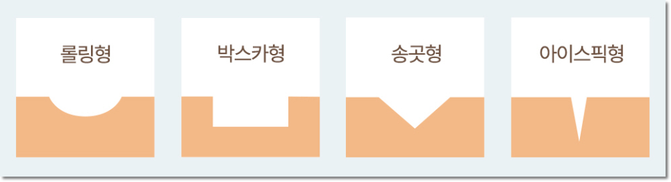 역삼동흉터치료 흉터지우개로 깨끗하게 관련 이미지 2