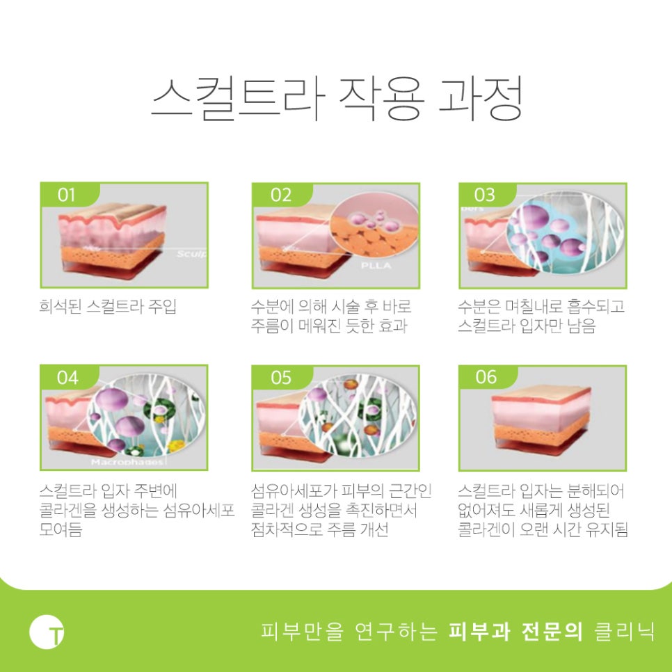 역삼동피부과 스컬트라로 콜라겐의 생성을 관련 이미지 3