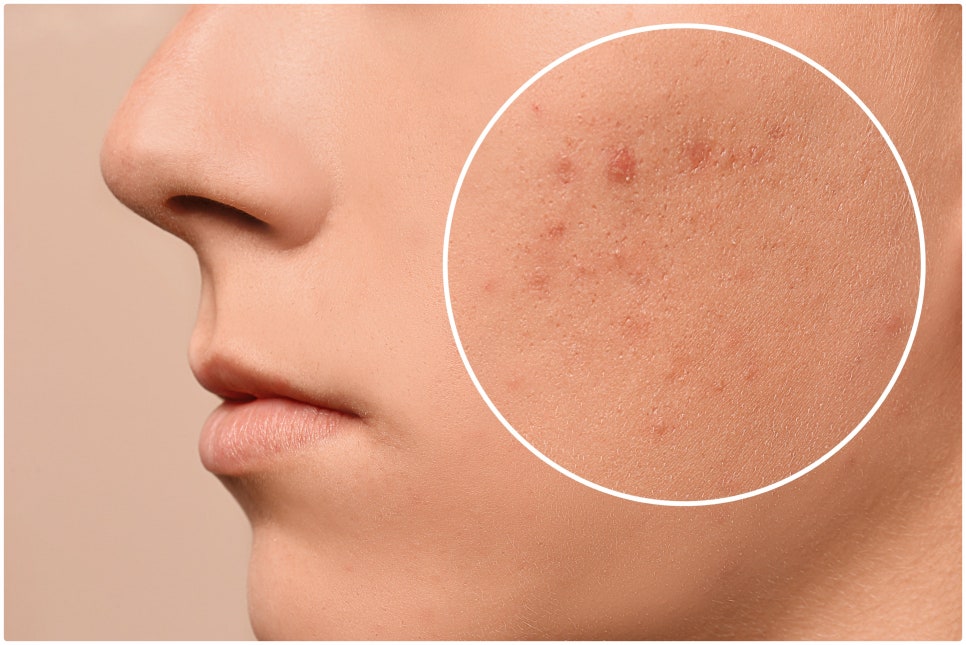 If You’re Stressed by Acne Scars, Yeoksam Gold PTT image 5