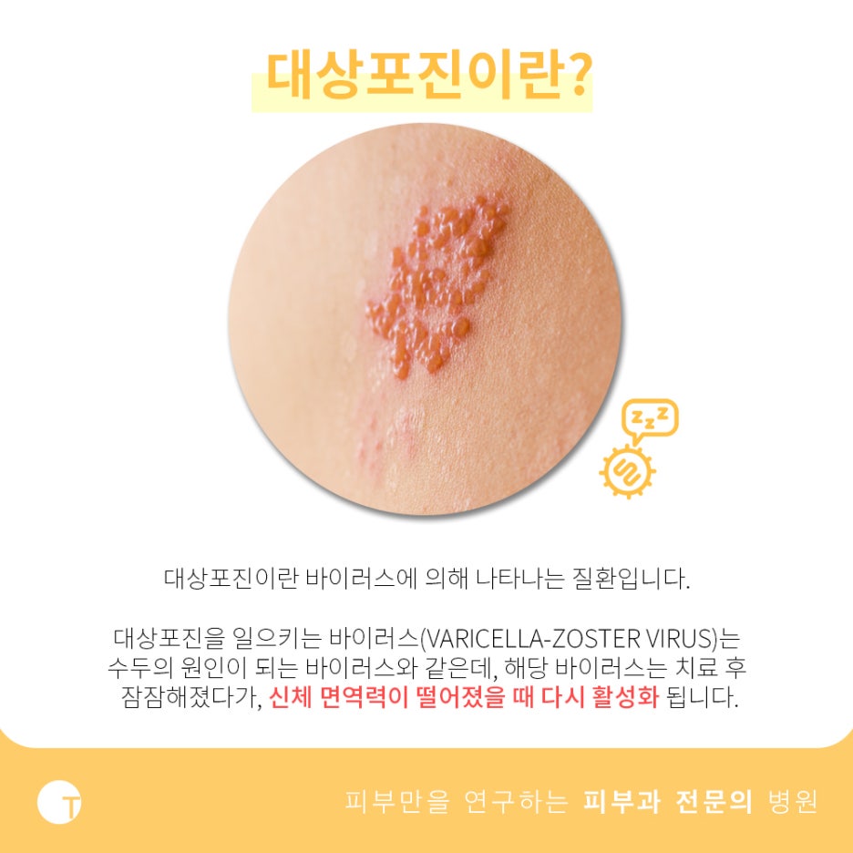대상포진 증상과 치료방법 알아봐요 관련 이미지 2