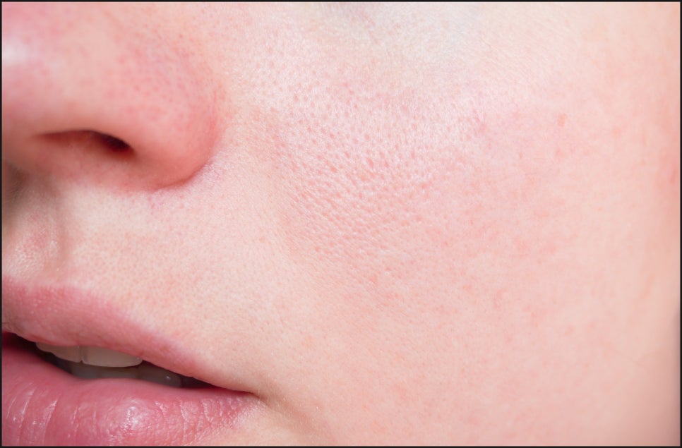 How Can Gangnam Yeoksam V-Beam Help with Facial Redness? image 1