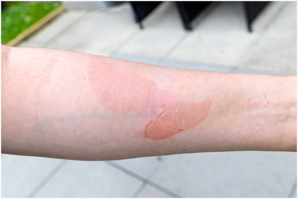 Are You Looking for a Gangnam Burn Treatment Dermatology Clinic? Before Scarring Occurs image 5
