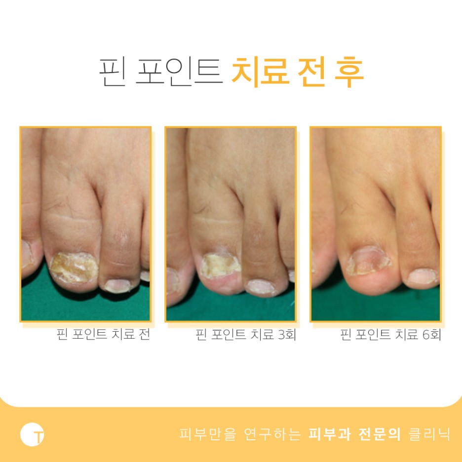 역삼동발톱무좀 미루지말고 해결해요 관련 이미지 5