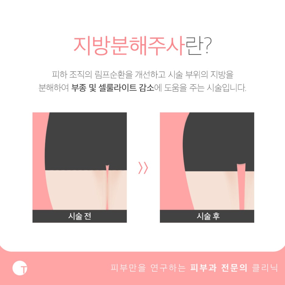 역삼역다이어트 지방분해주사로 슬림하게 관련 이미지 2