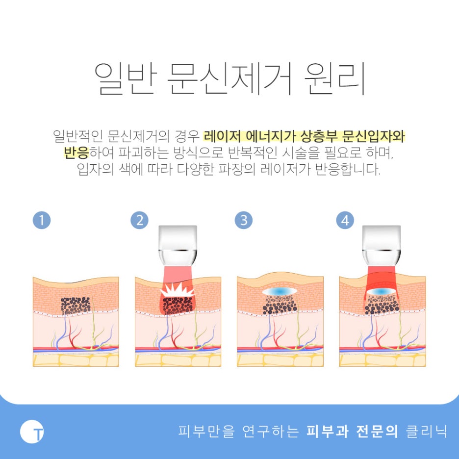 역삼역눈썹문신제거 깔끔하게 하려면 관련 이미지 2