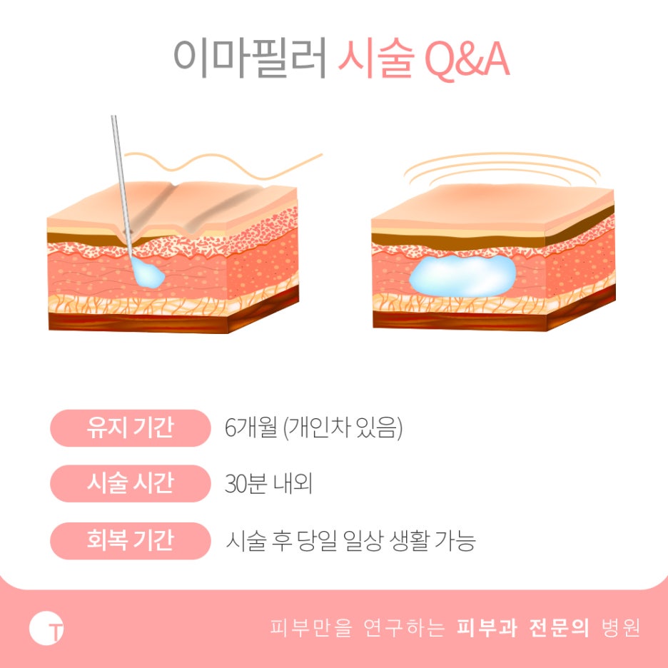 역삼역이마필러 짧은 시간에 확실한 볼륨을 관련 이미지 4