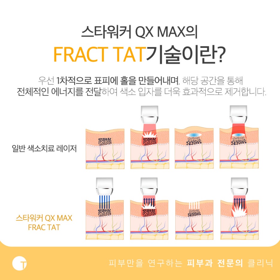 스타워커 레이저 어떤 점이 좋을까 관련 이미지 3