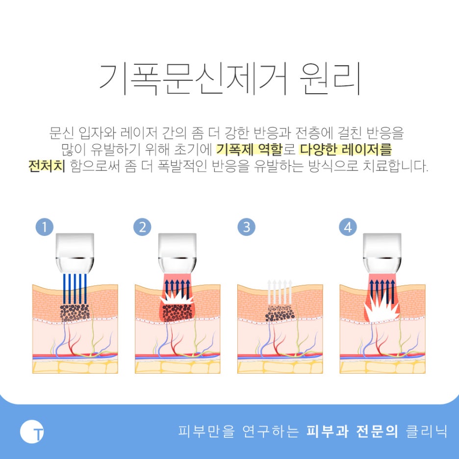역삼역눈썹문신제거 깔끔하게 하려면 관련 이미지 3
