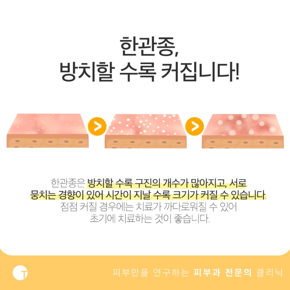 한관종 아그네스 치료 재발 없이 확실하게 관련 이미지 4