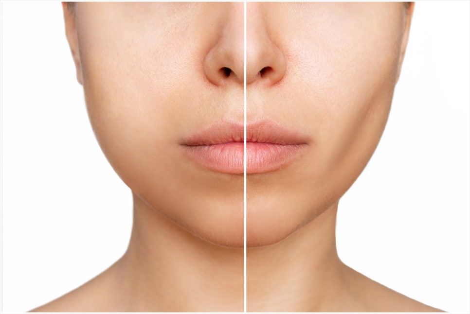 If you Are Considering Yeoksam Juvederm Filler image 10