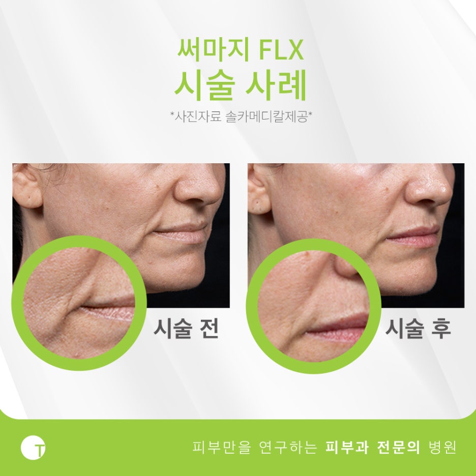 역삼동써마지 FLX 고주파레이저로 관리해요 관련 이미지 8