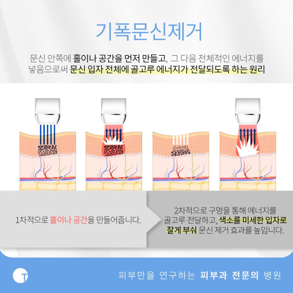 역삼동문신제거 피부손상은 줄이고 효과는 높이고 관련 이미지 4